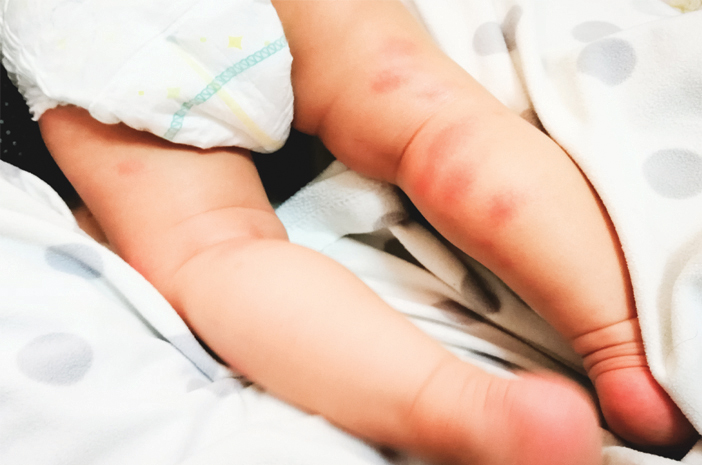 الطفح الجلدي على جسم الطفل يمكن أن يكون فرفرية هينوخ شونلاين