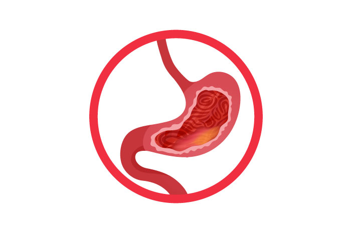 Mitos atau Fakta, Tekanan Berat Menyebabkan Gastritis