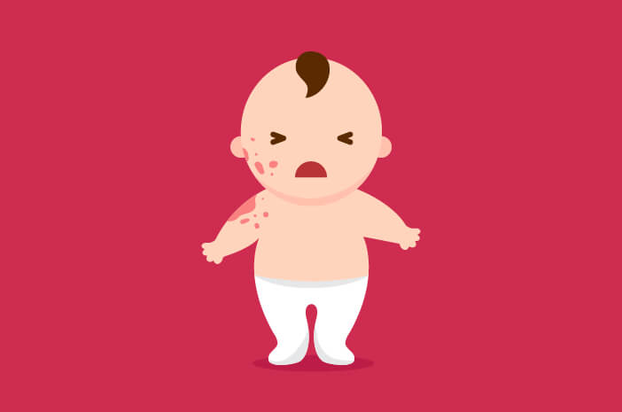 4 Petua untuk Ibu Sekiranya Bayi Mengalami Dermatitis Atopik