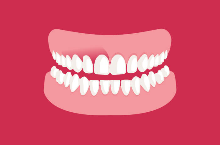 知っておくべきこと、ここに歯肉炎を予防する5つの方法があります