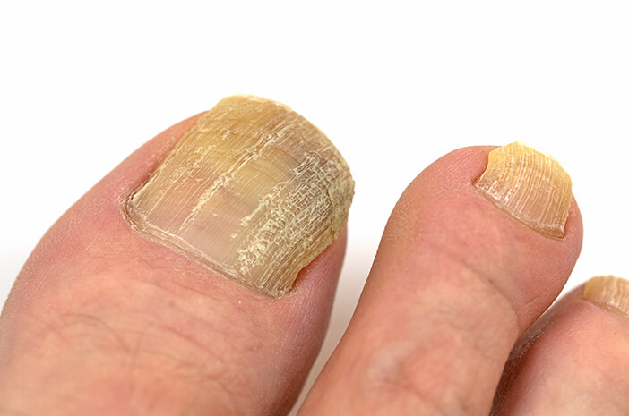 Idap乾癬は足の爪の真菌を取得するリスクを高めます