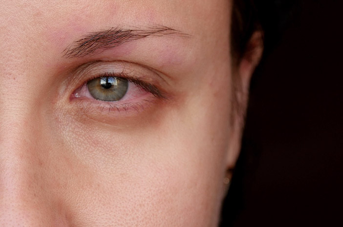 Донякъде подобно, каква е разликата между червените очи и симптомите на COVID-19?
