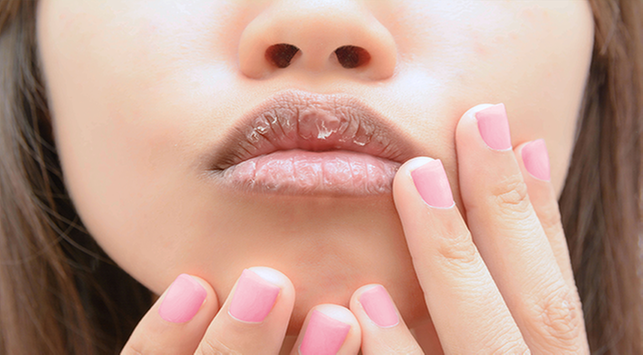 5 начина да преодолеете проблема с напуканите устни по време на гладуване