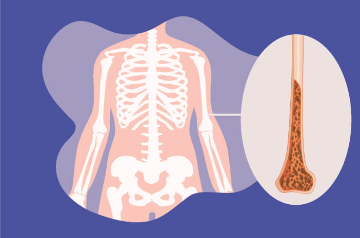 Ketahui Punca Osteoporosis