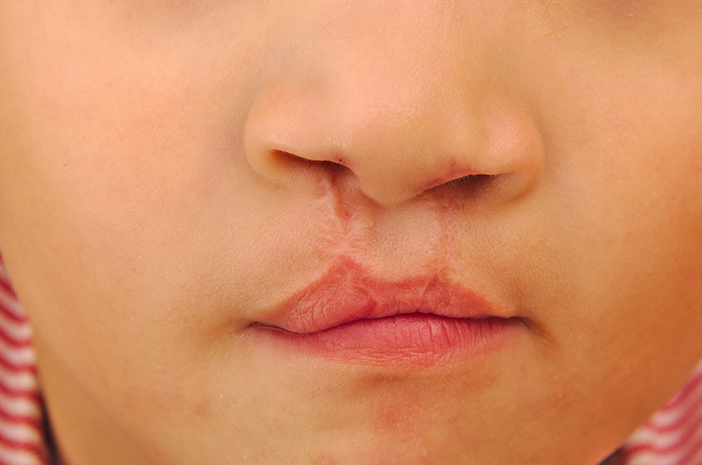 5 cause dei bambini nati con il labbro leporino